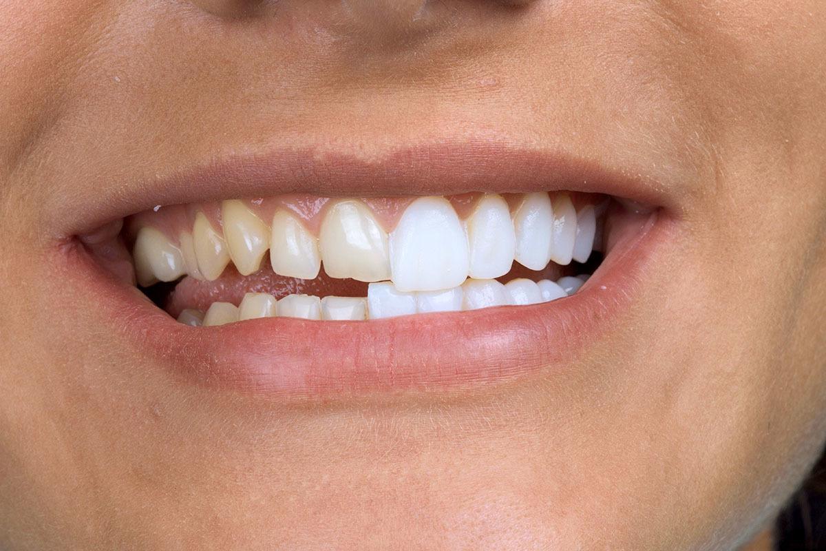 Зачем нужны виниры для зубов?